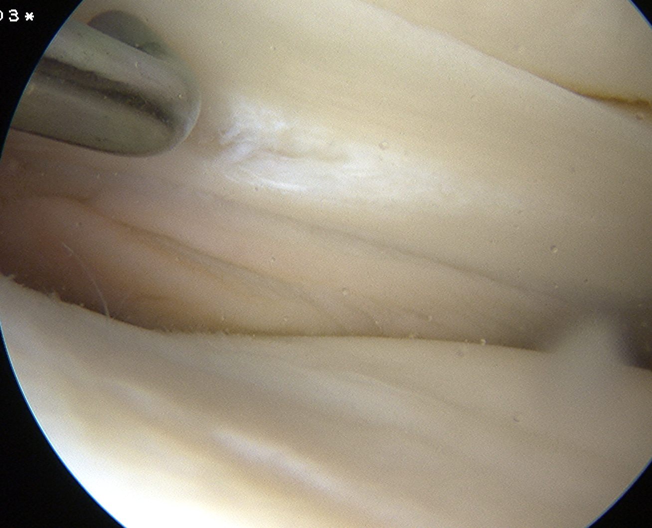 Lateral Meniscus Posterior Horn Tear Post ACL Rupture